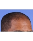 Before Hair Transplant&nbsp;Front